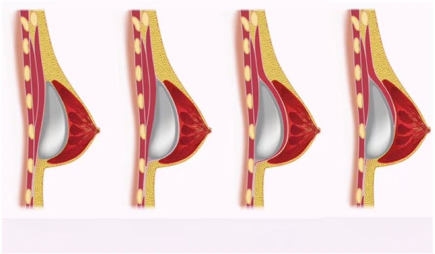 přístup pro instalaci implantátu